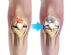 Knee Pain