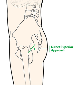 Direct Superior Hip Approach