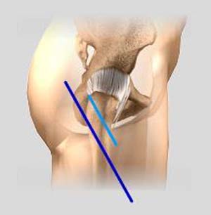 Mini-Posterior Hip Replacement