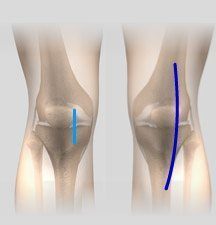 Robotic Unicondylar Knee Replacement