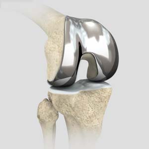  Meniscal Surgery