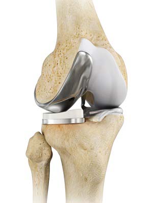  Unicompartmental/Partial Knee Replacement