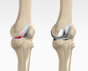 Robotic Unicondylar Knee Replacement